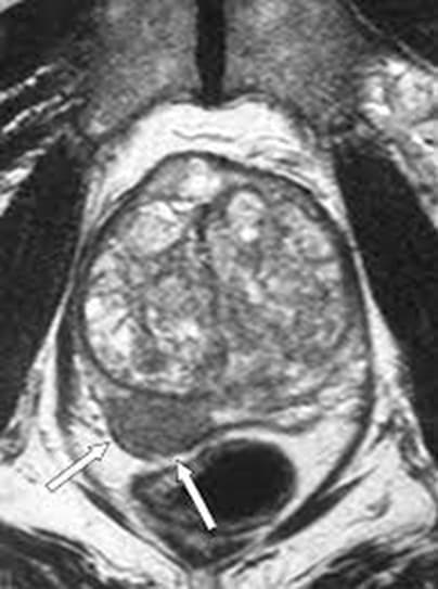 What MRI Tells Your Doctor About What to Do Next?
